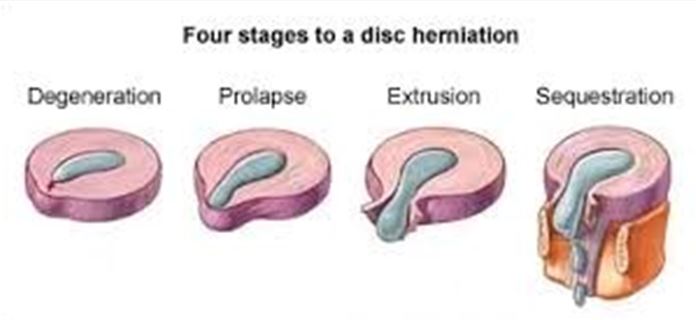 disc herniation